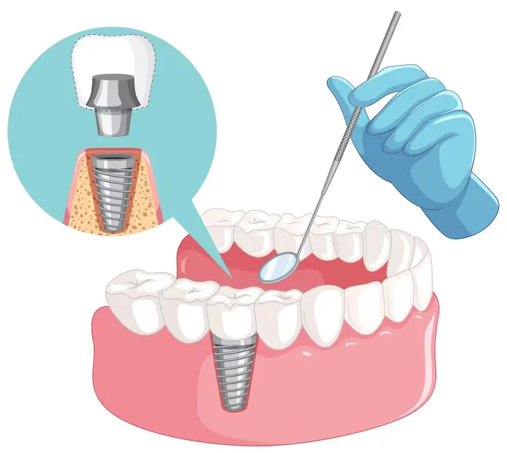 What are Dental Implants, and How Do They Work